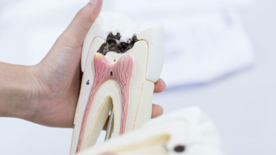 Recognizing Cavities: Early Signs and What to Do